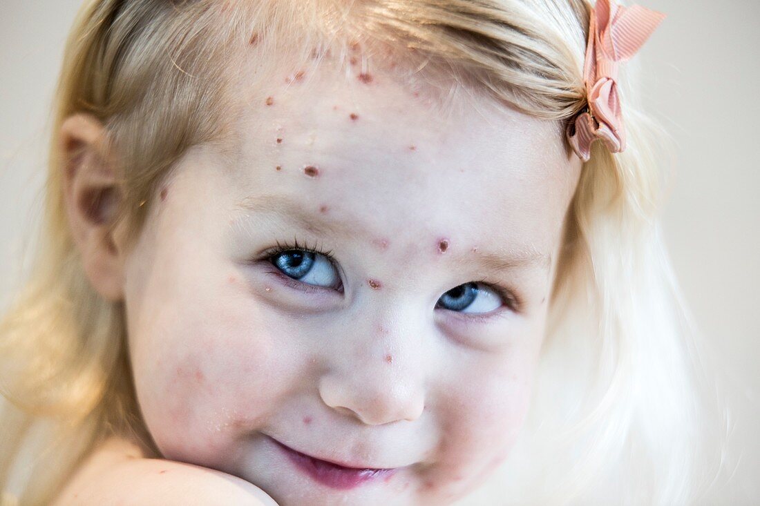 Girl with chickenpox