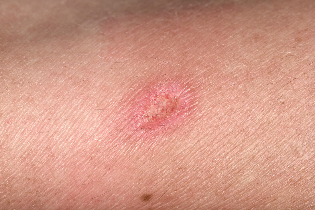 Infected spider bite