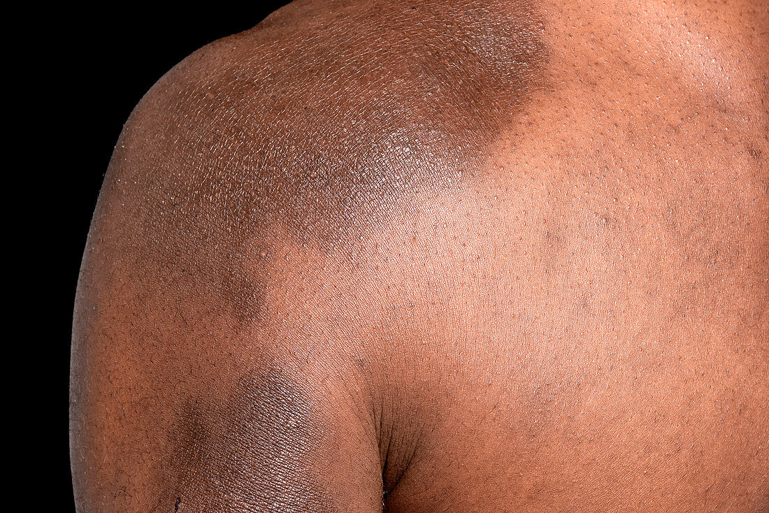 Post-inflammatory pigmentation in eczema