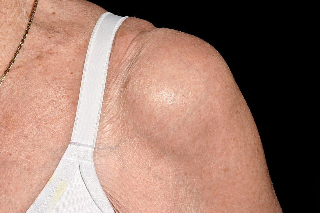 Shoulder effusion in osteoarthritis