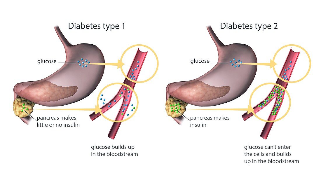 Type 1 and 2 diabetes,illustration
