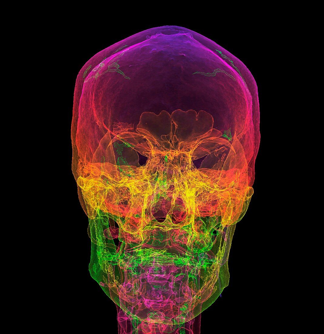 Normal human skull,3D CT scan