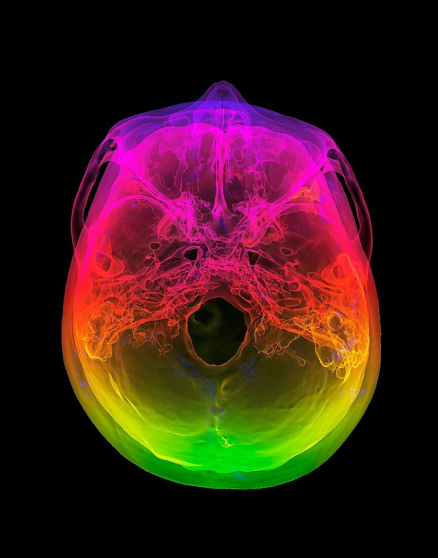 Normal human skull,3D CT scan