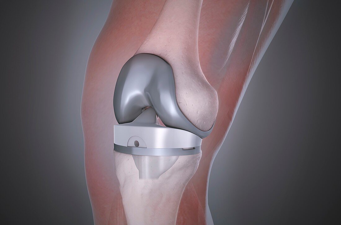 Knee after knee replacement,illustration
