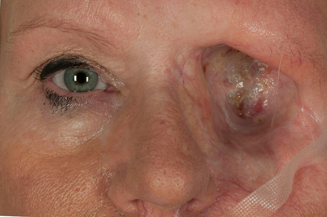 Eye removed in skin cancer
