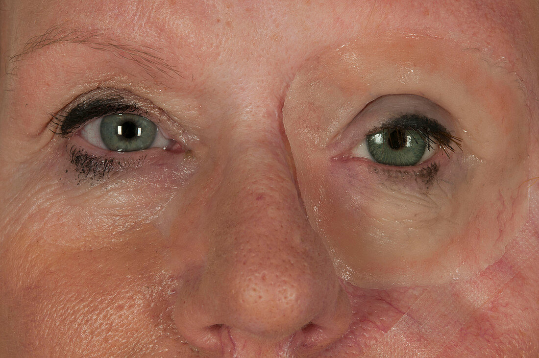 Eye removed in skin cancer