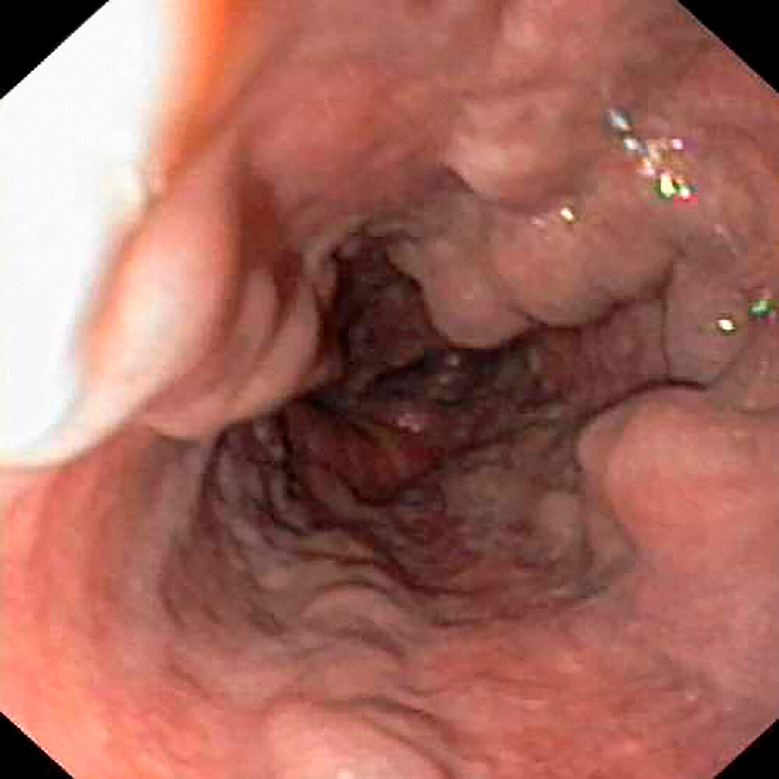 Oesophageal varices