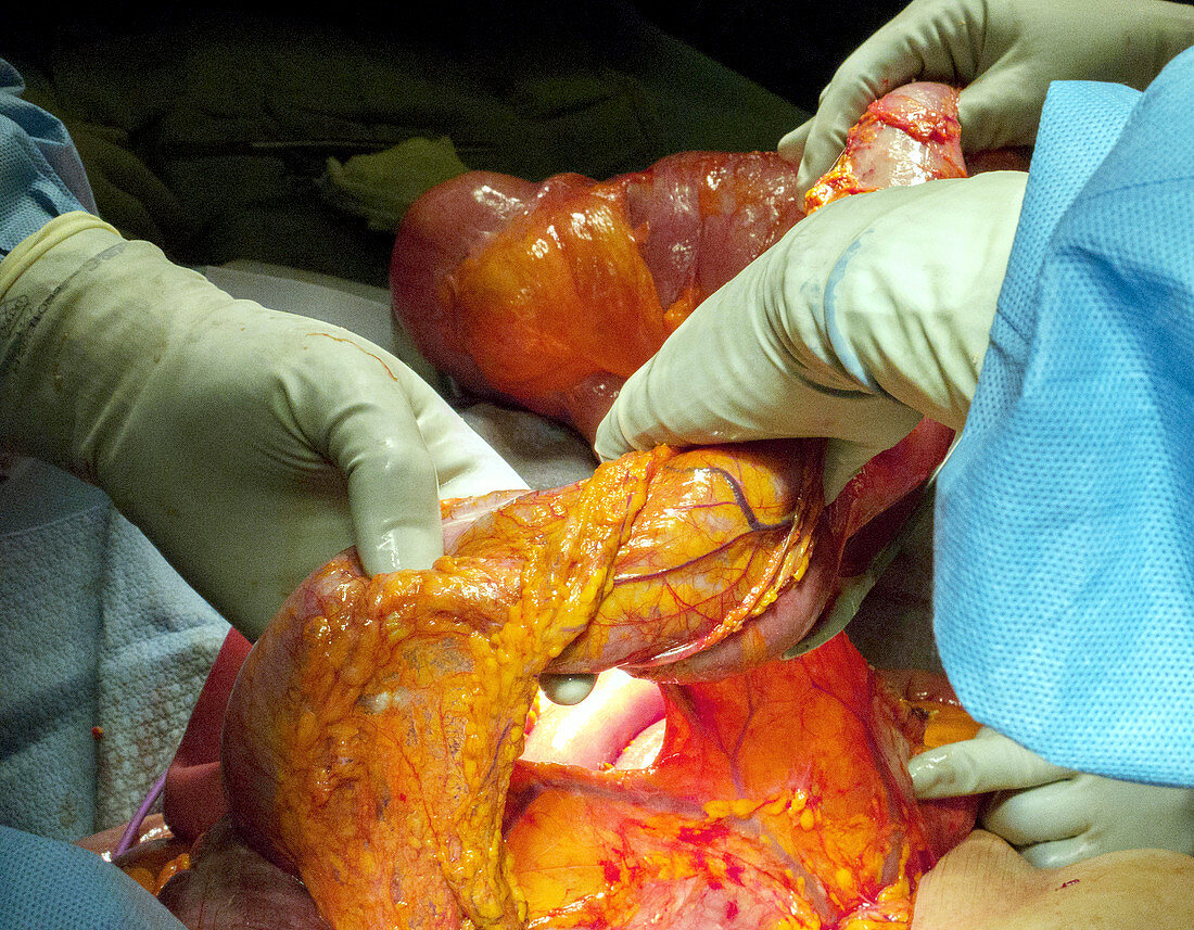 Megacolon resection in ischaemic colitis