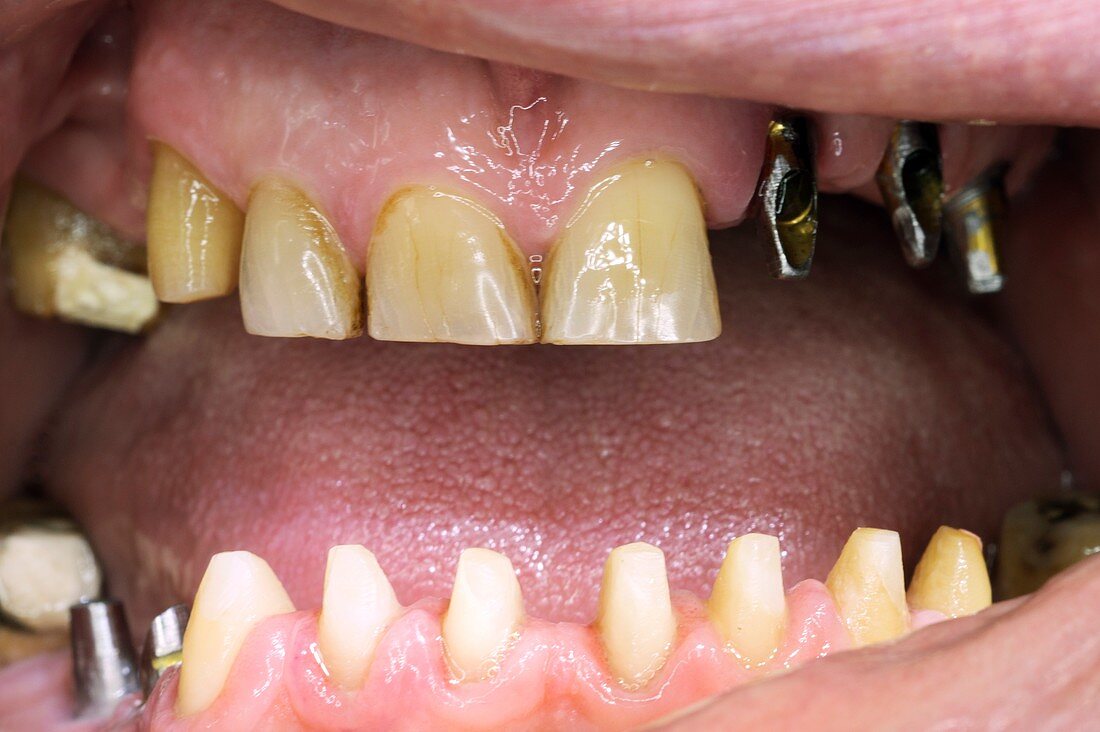 Dental implant fixtures