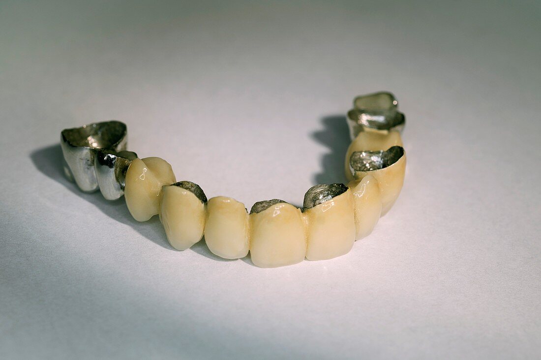 Dental metal-ceramic bridge set