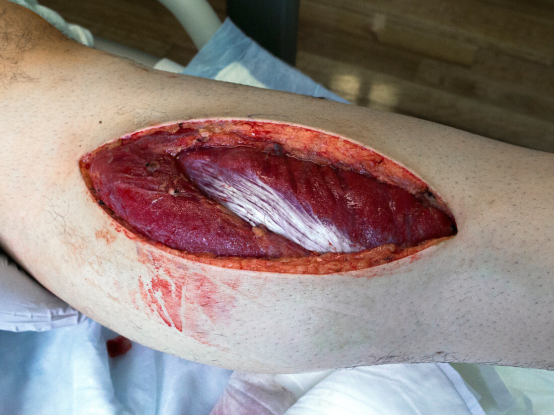 Fasciotomy for compartment syndrome