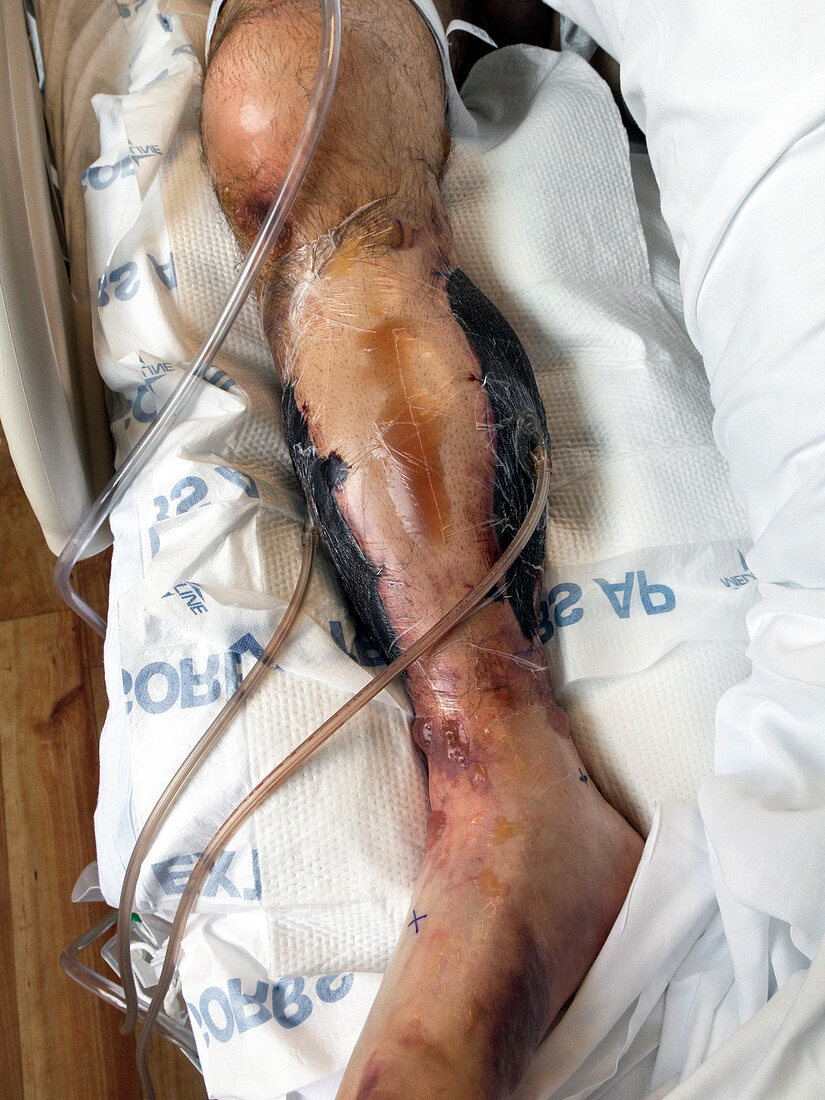Woundcare for compartment syndrome