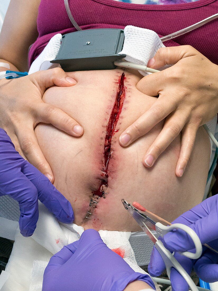 Woundcare in pregnant woman