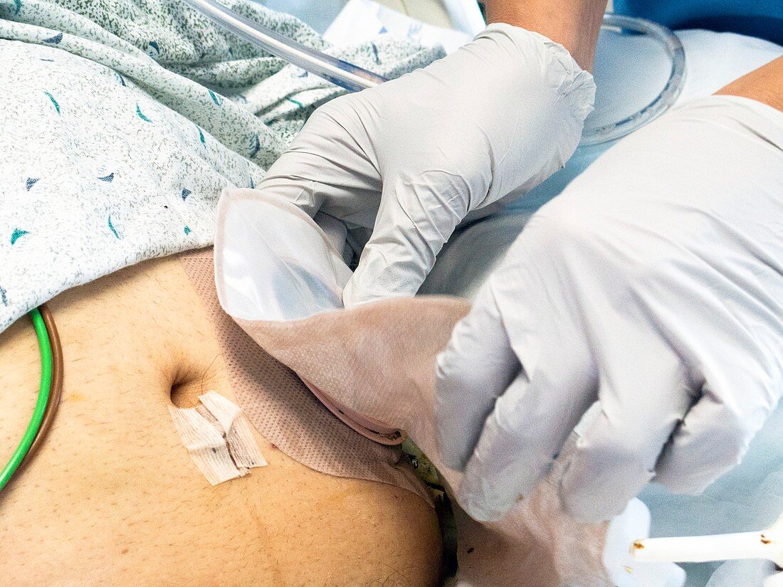 Colostomy pouch handling