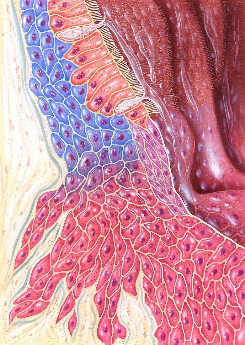 Lung cancer tissue,illustration
