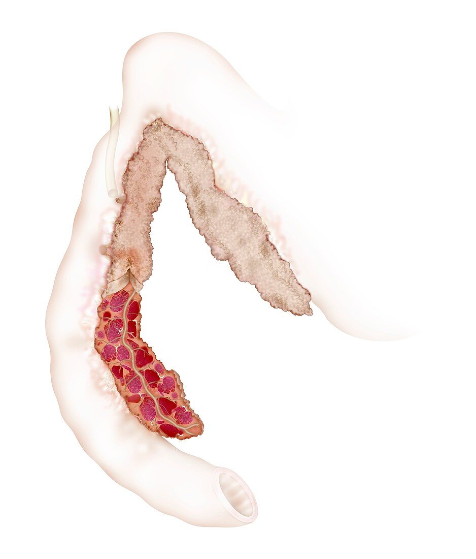 Diseased canine pancreas,illustration