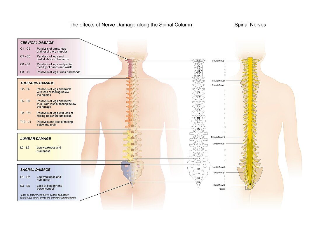 Spinal nerve damage,illustration