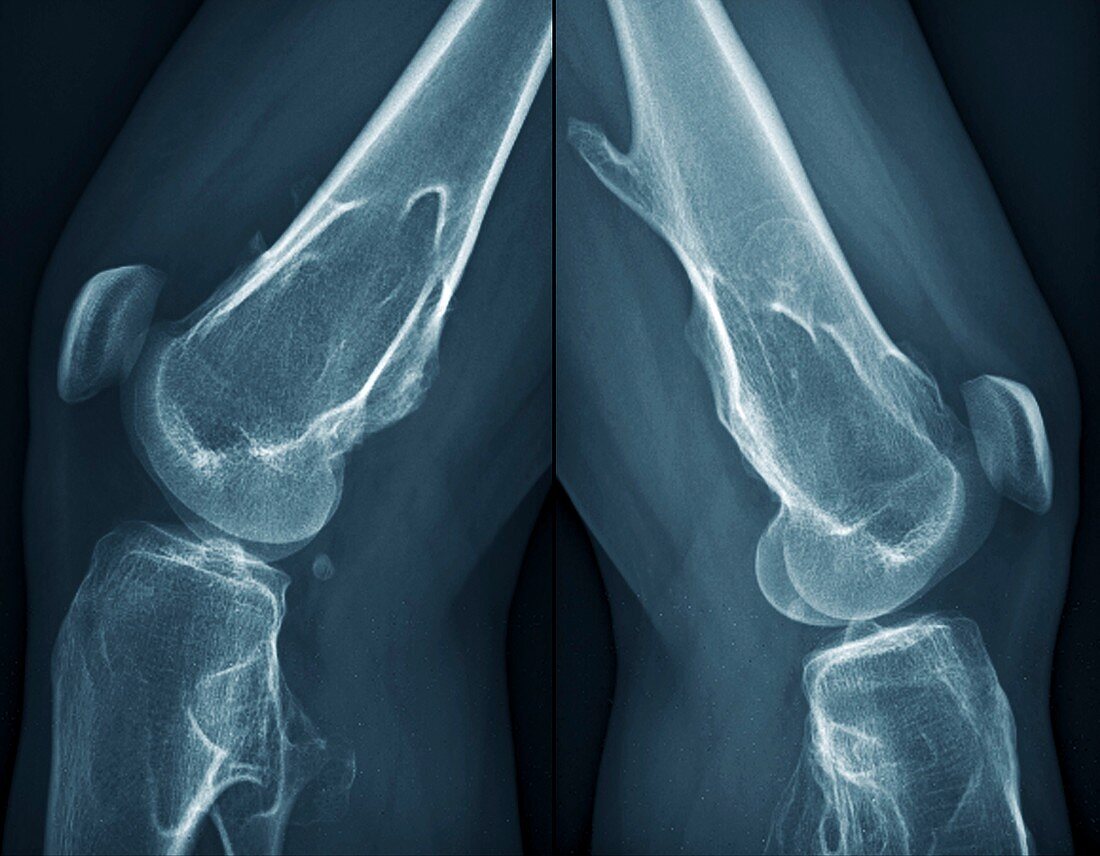 Knees in Ollier disease,X-ray