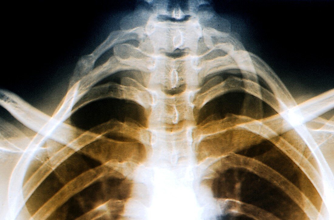 Extra rib,X-ray