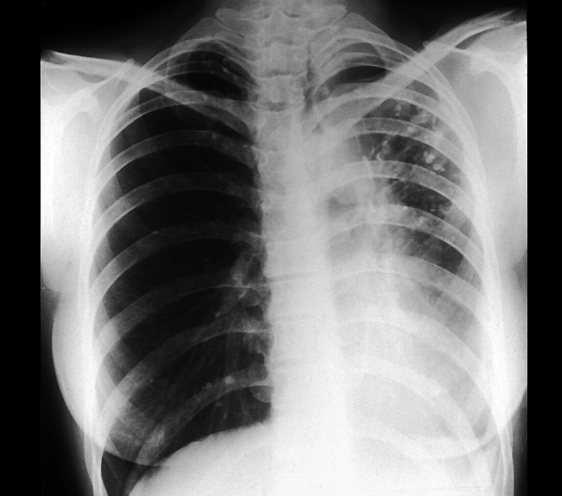 Bronchiectasis,X-ray