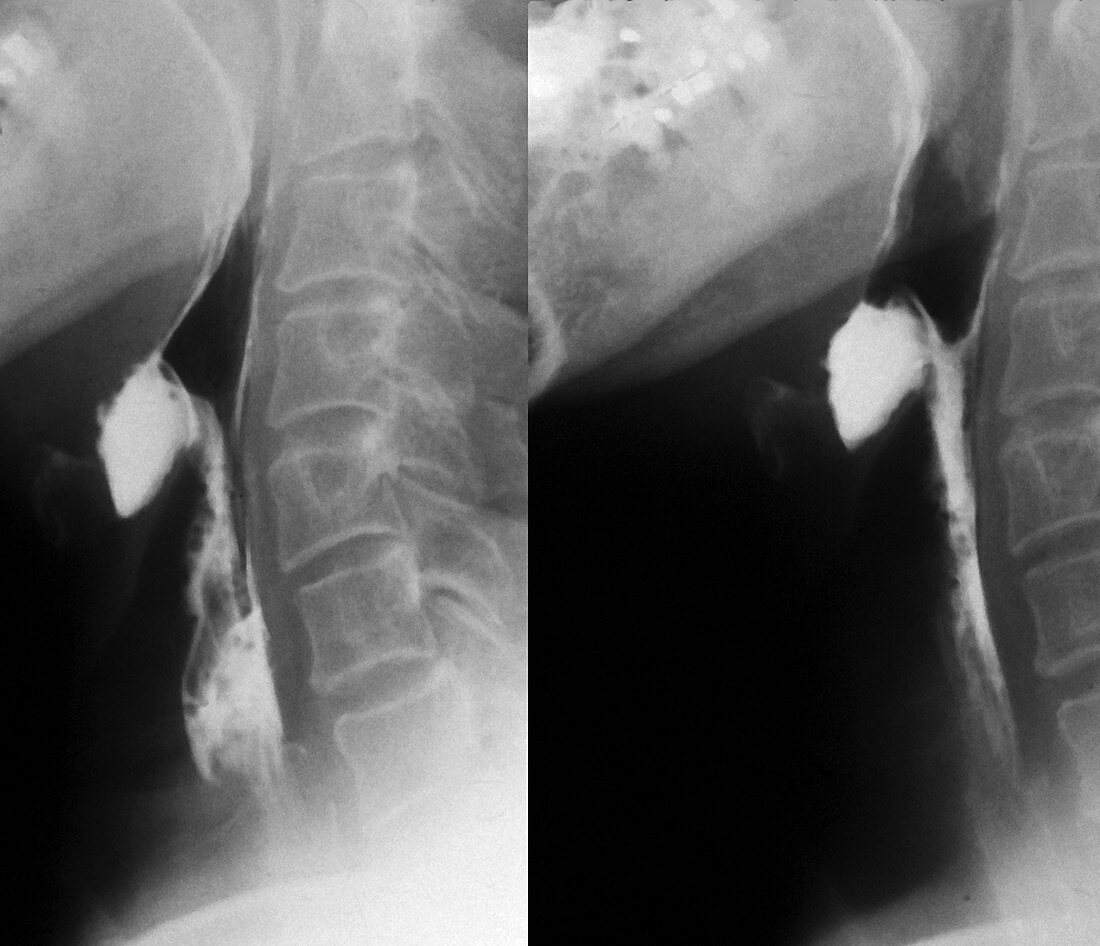 Laryngeal tumour,X-ray
