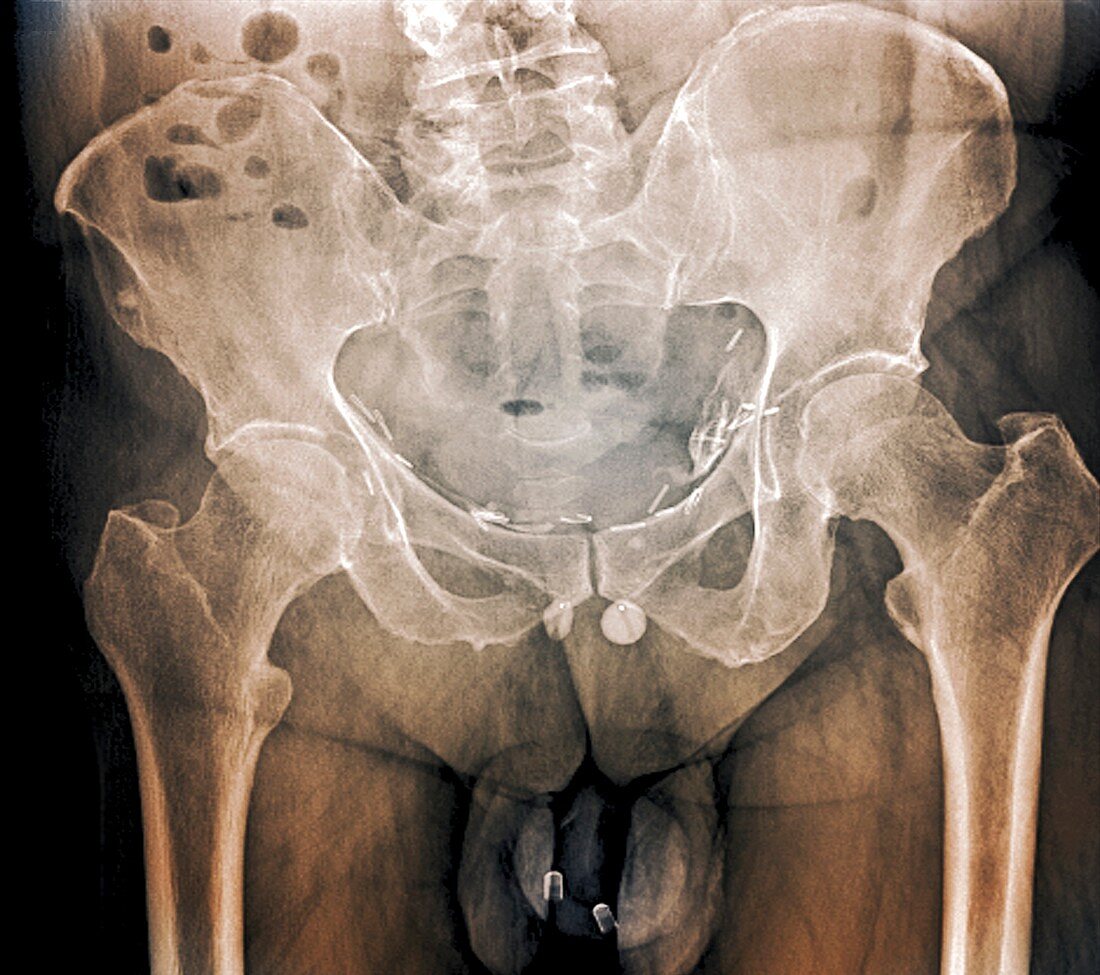 Incontinence implant,X-ray