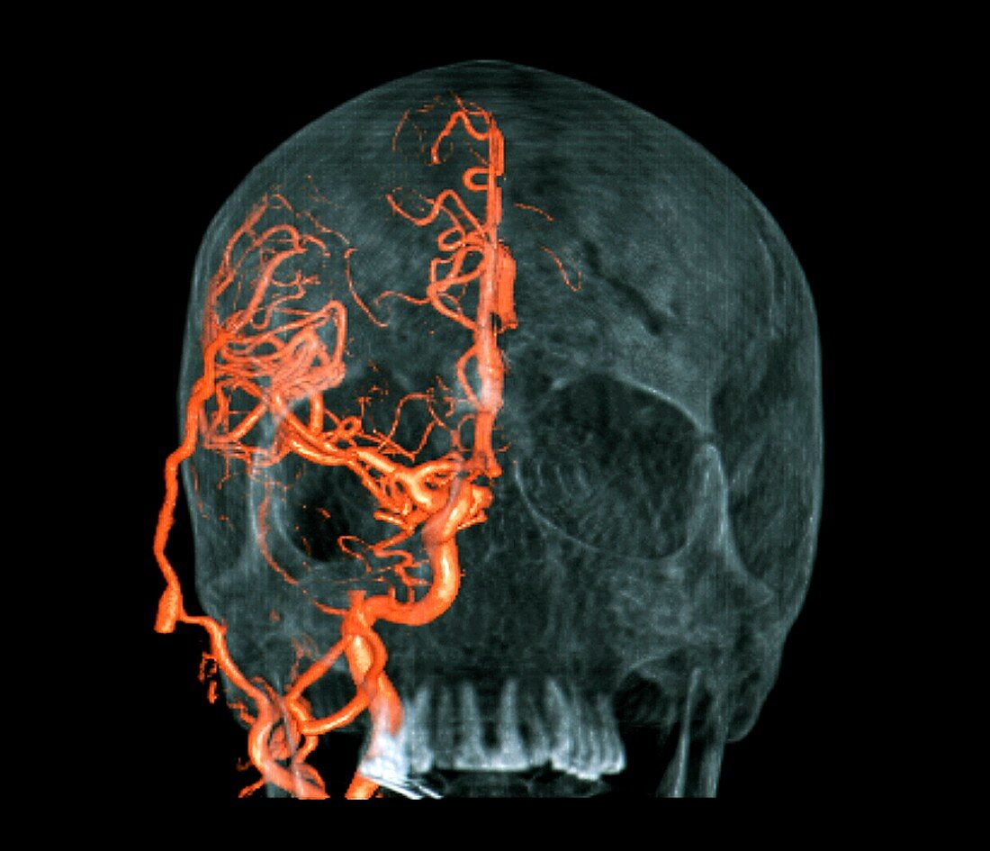 Brain haemorrhage,3D CT scan