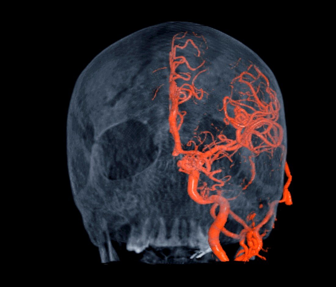 Brain haemorrhage,3D CT scan