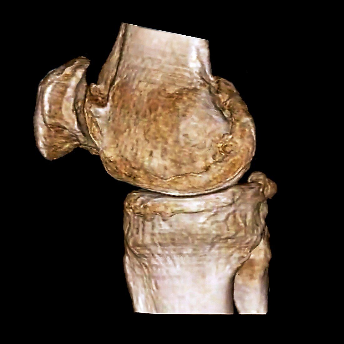 Osteoarthritis of the knee,3D CT scan