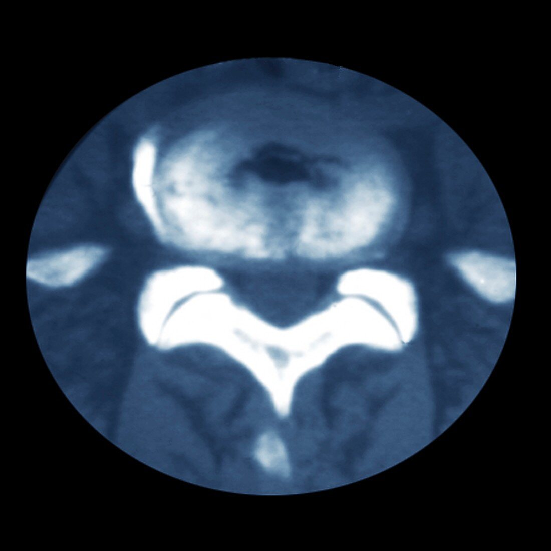 Spinal disc protrusion,CT scan