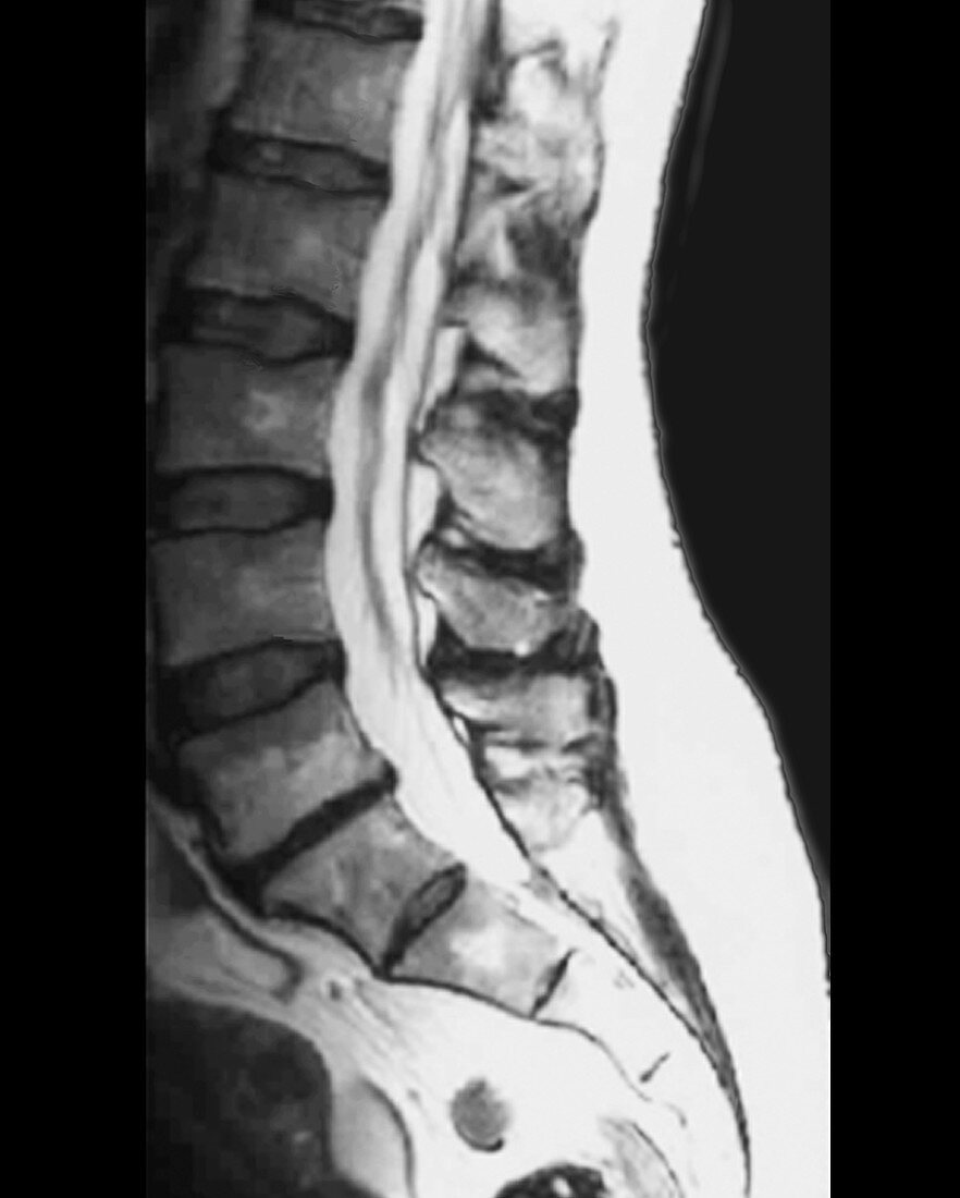Spinal disc degeneration,CT scan