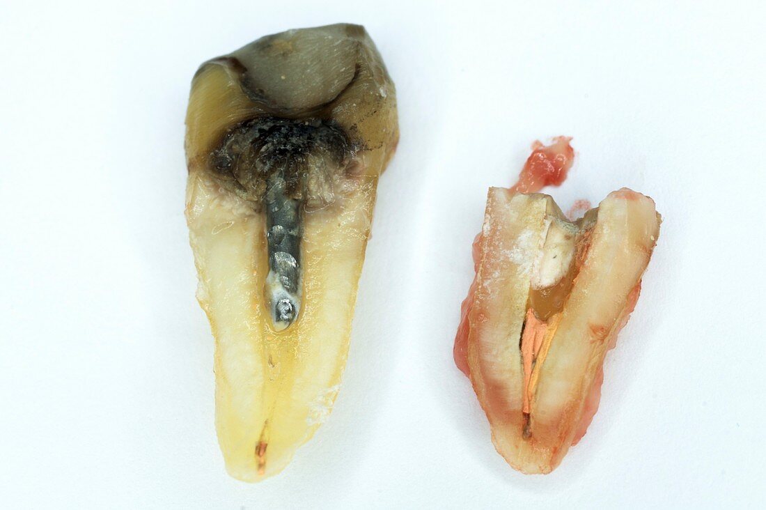 Extracted premolar tooth and root