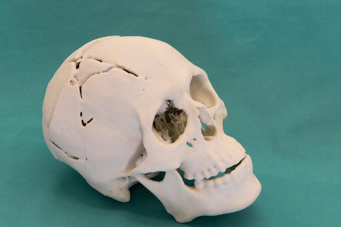 Forensics 3D autopsy reconstruction