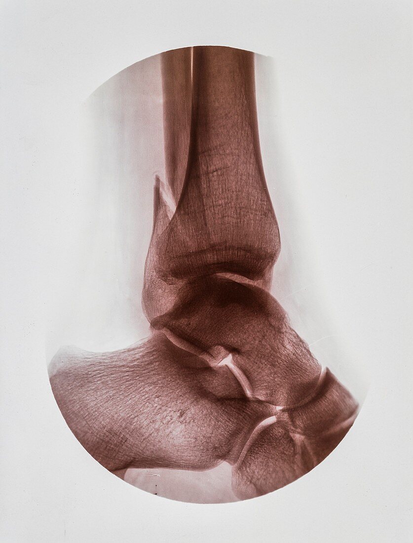 Ankle fracture X-ray,early 20th century