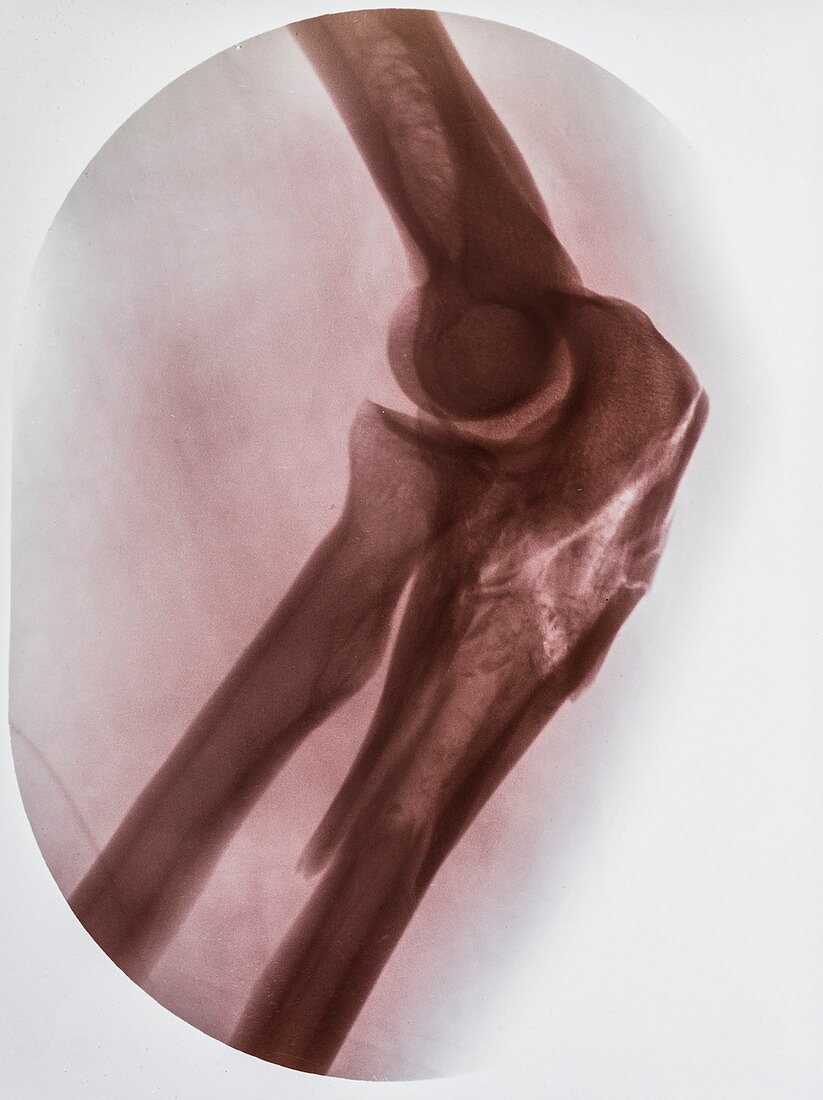Tibia fracture X-ray,early 20th century