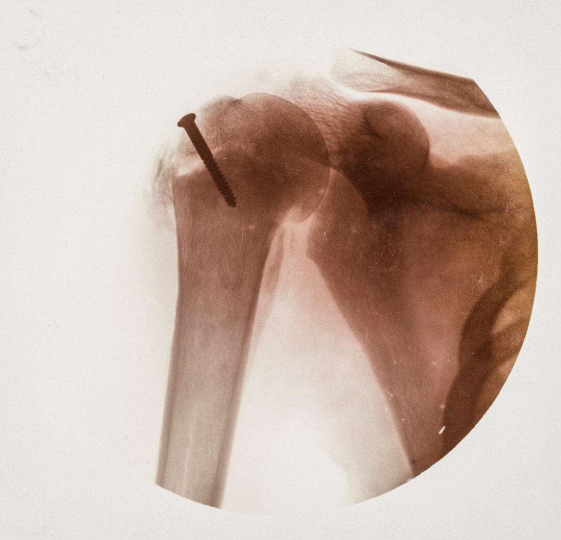 Shoulder screw X-ray,early 20th century