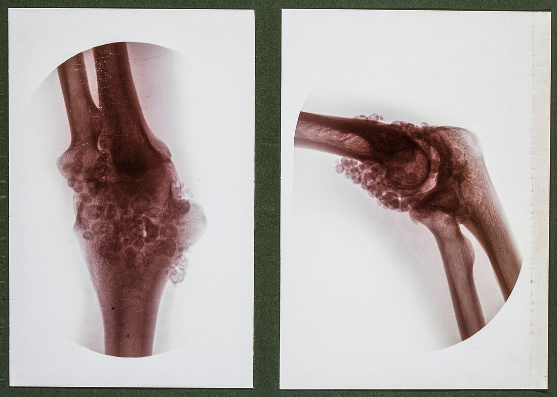 Joint deformity X-ray,early 20th century