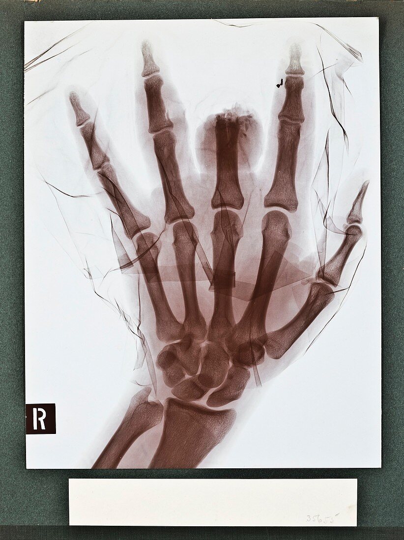 Finger injury X-ray,early 20th century