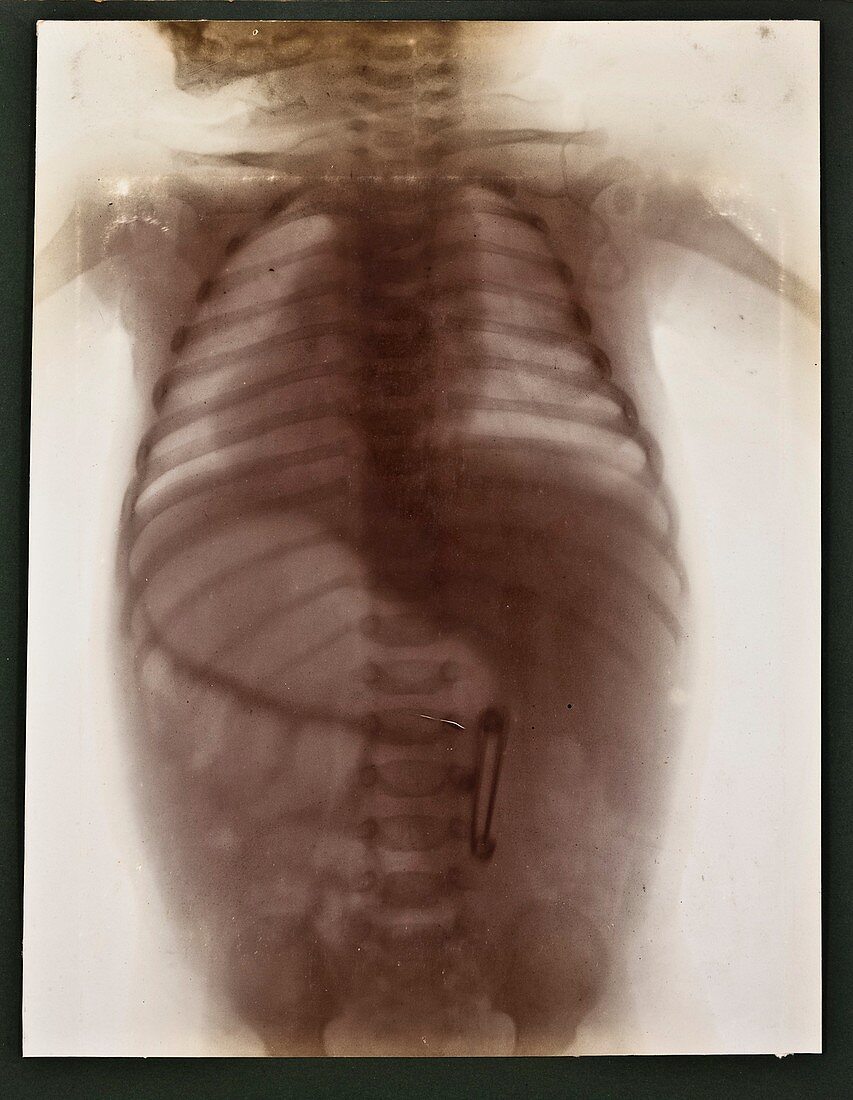 Foreign body X-ray,early 20th century