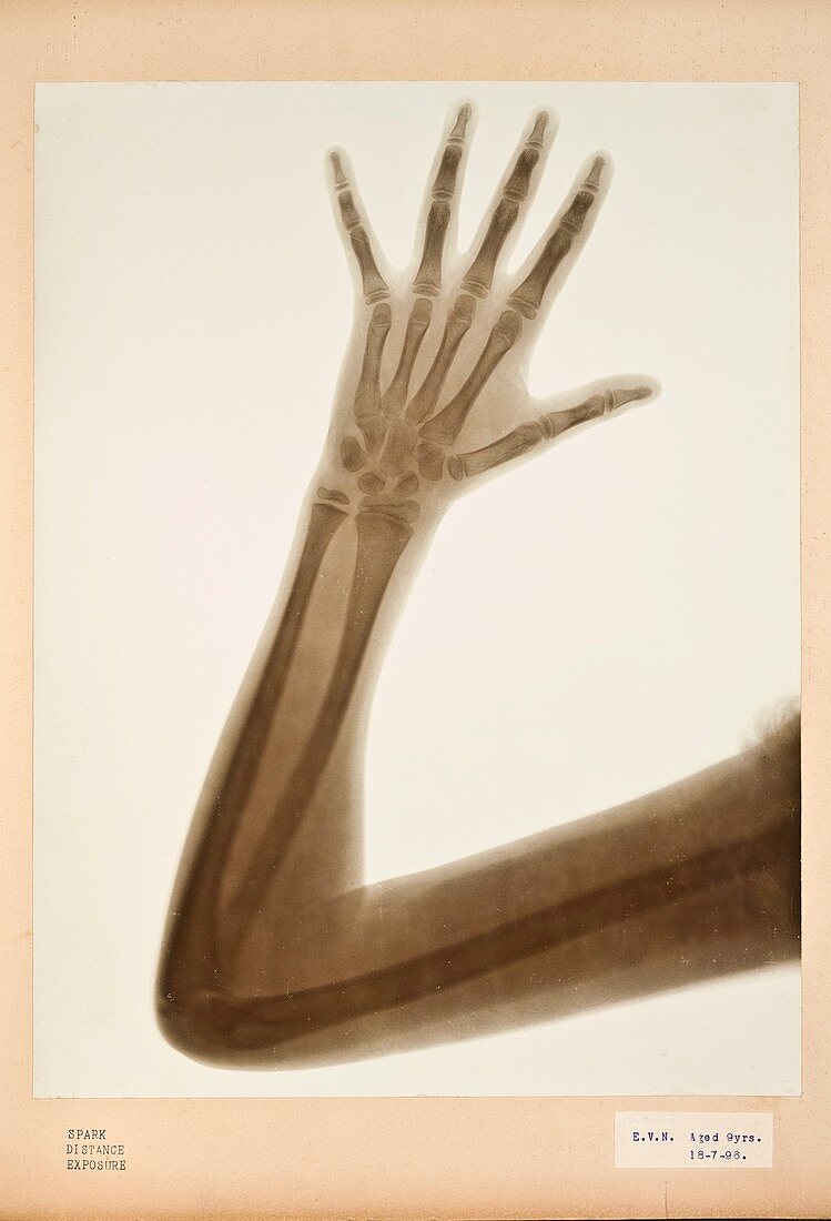 Child's arm X-ray,1896