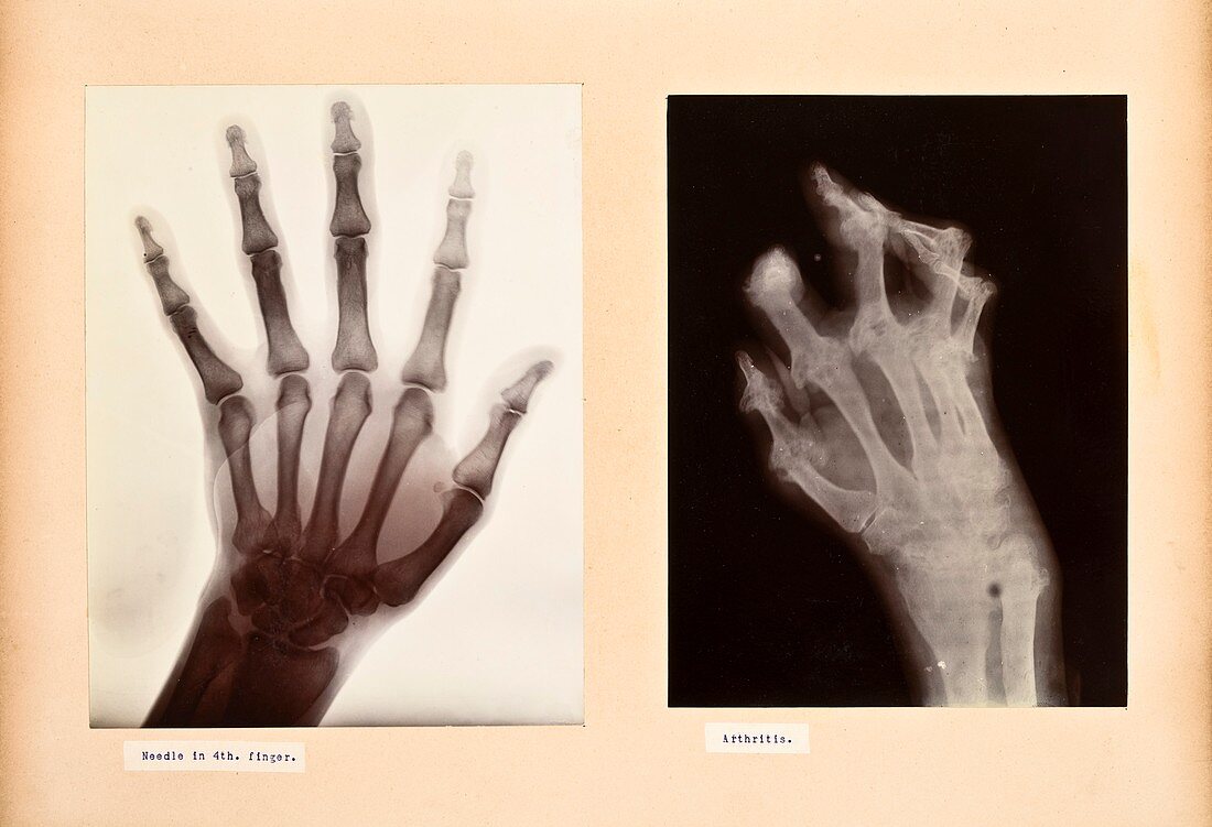 Hand disorder X-rays,early 20th century