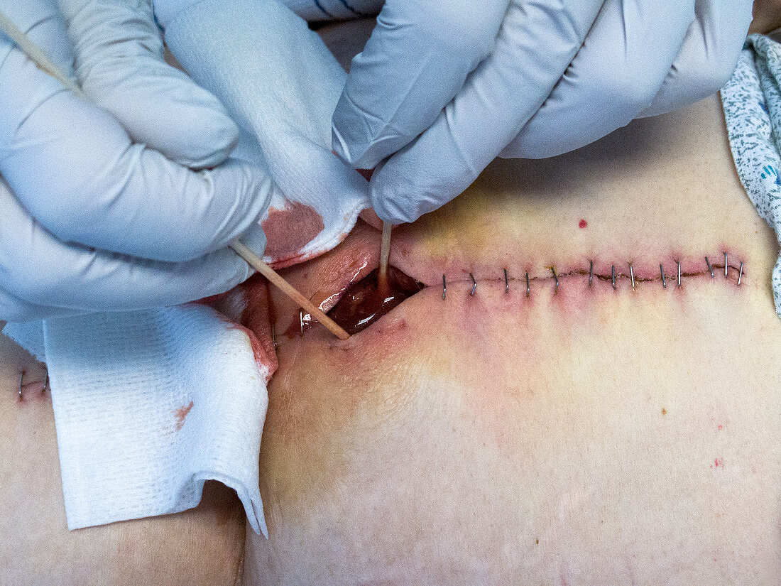 Draining pus from infected surgical wound