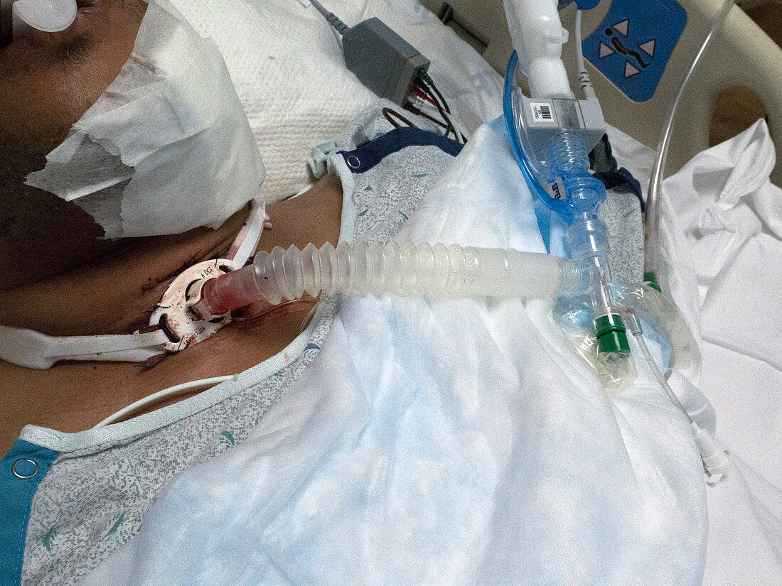 Intensive care patient with tracheostomy