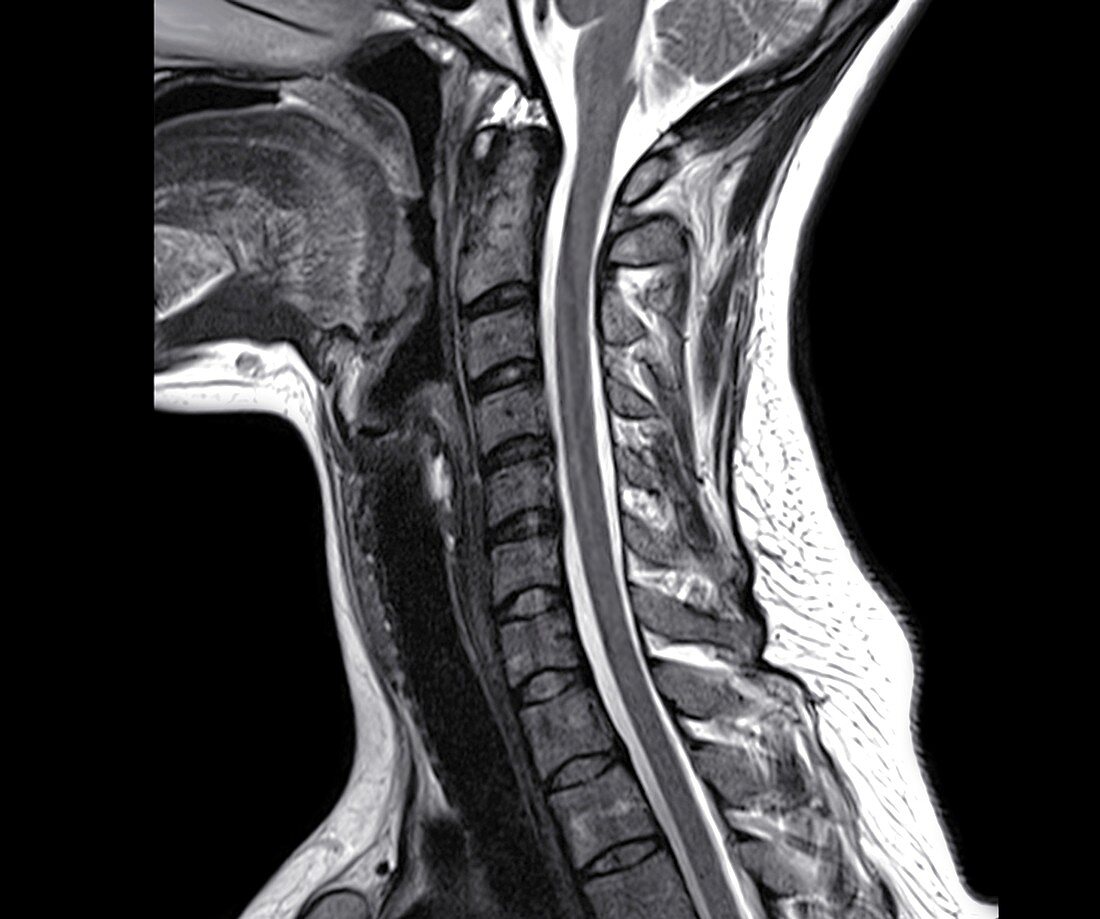 Normal cervical vertebra,MRI scan