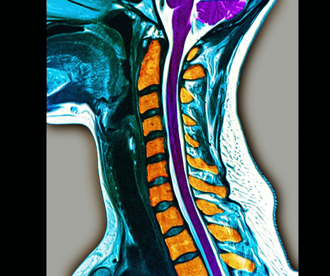 Normal cervical vertebra,MRI scan