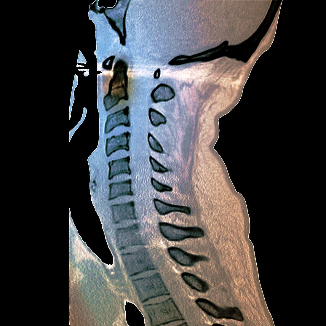 Spinal fracture,CT scan
