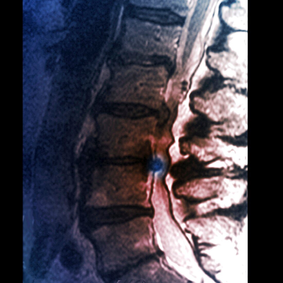 Slipped disc in spinal stenosis,X-ray