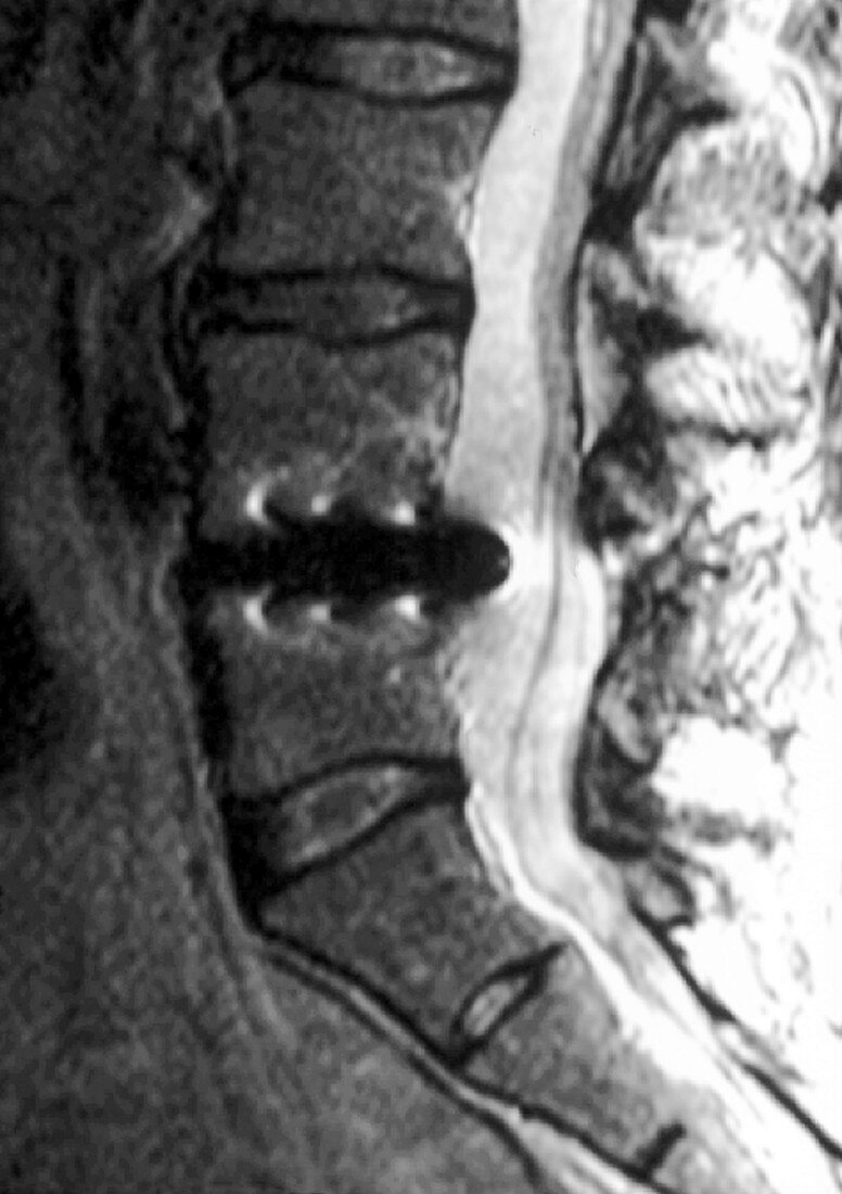Spinal disc replacement,MRI