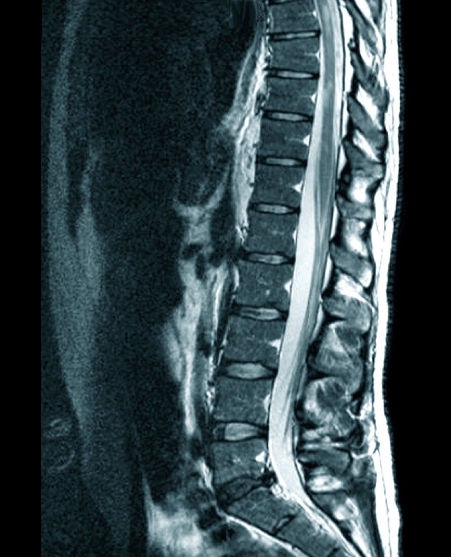 Spine in multiple sclerosis,MRI