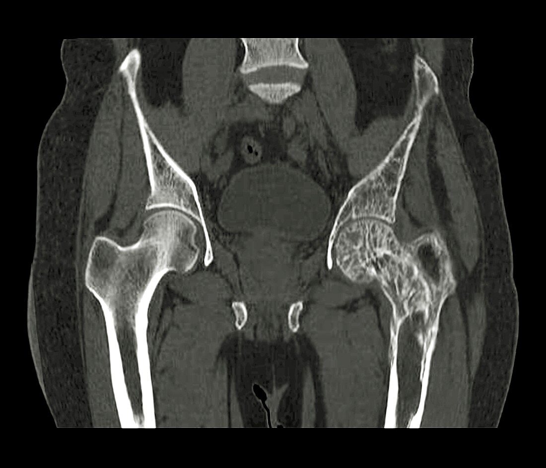 Hips in Paget's disease,CT scan